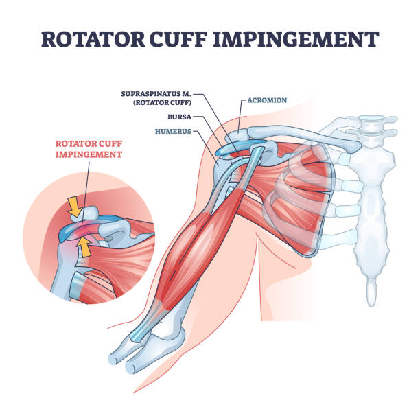 Rotator cuff shoulder pain